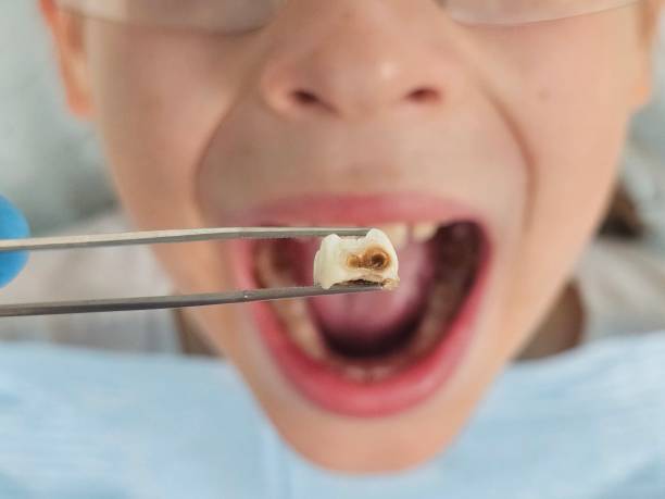 Best Knocked-Out Tooth (Avulsed Tooth) Treatment in Casper, WY